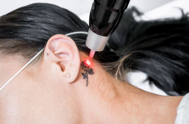 Does Tattoo Removal Work, Laser Tattoo Removal